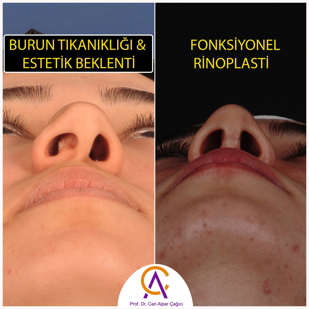 Hem burun tıkanıklığı hem de estetik beklentisi olan fonksiyonel rinoplasti yapılan kadın hastanın öncesi sonrası fotoğrafları
