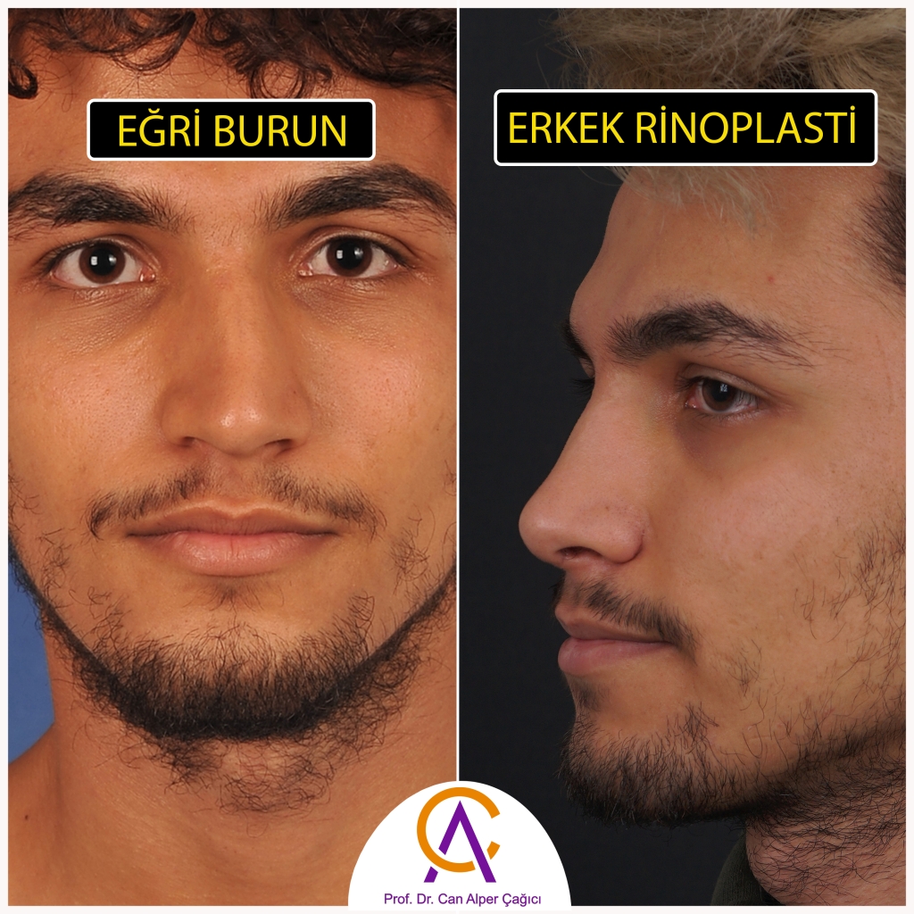 Eğri burun deformitesi olan Adana'da burun estetiği ameliyatı rinoplasti yapılan olan erkek hastanın öncesi sonrası fotoğrafları