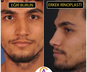 Erkek Rinoplasti