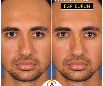 Eğri Burun