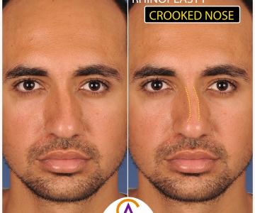 Crooked Nose