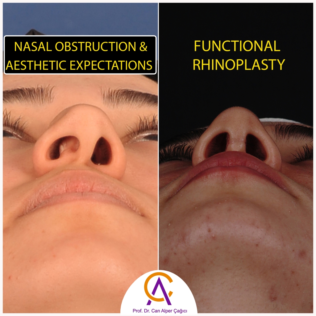 Before and after photos of a female patient in Adana who underwent functional rhinoplasty surgery, also suffering from nasal congestion.