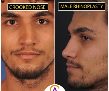 Male Rhinoplasty