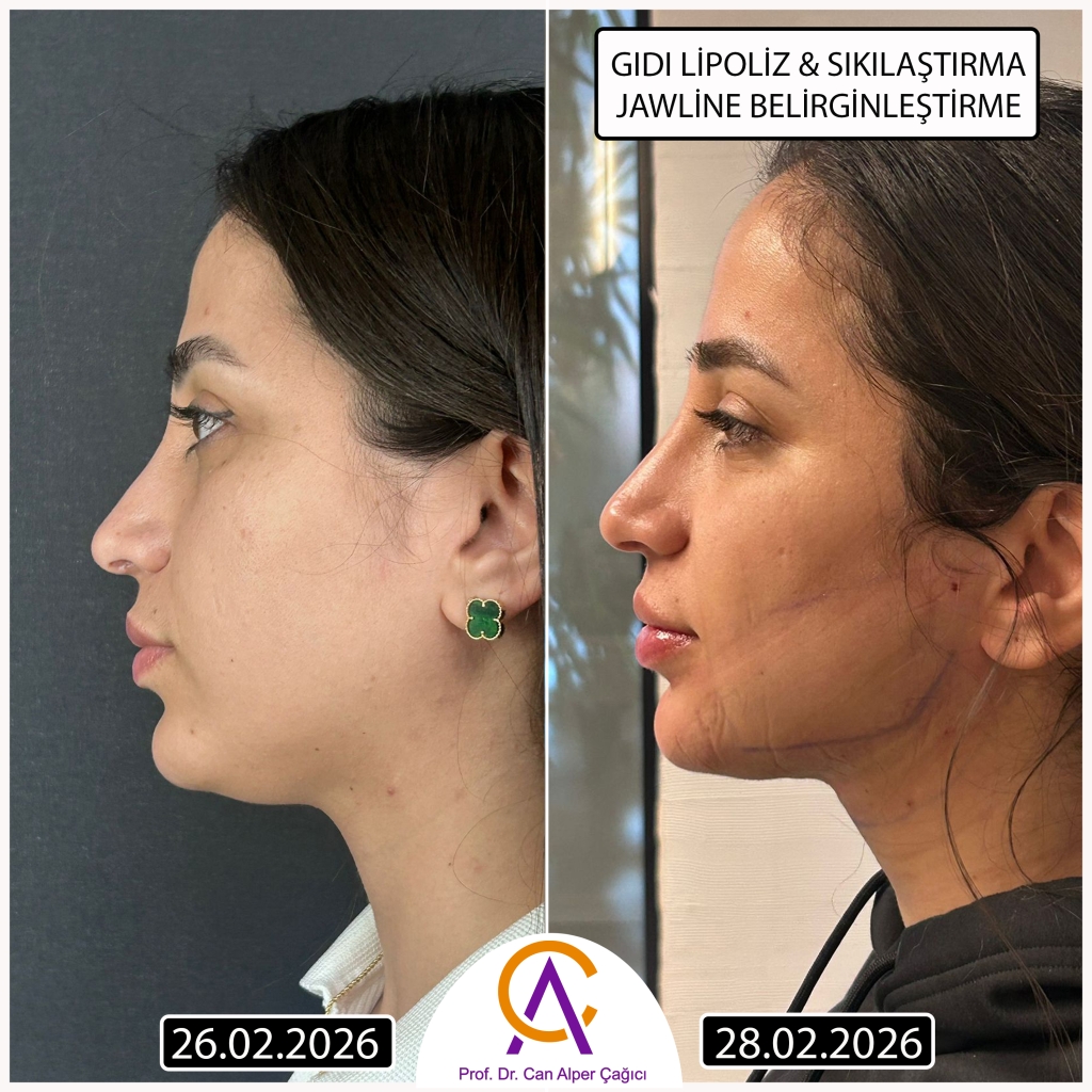 Adana’da Endolift lazer ile gıdı lipoliz ve jawline belirginleştirme öncesi ve 2 gün sonrası yan profil