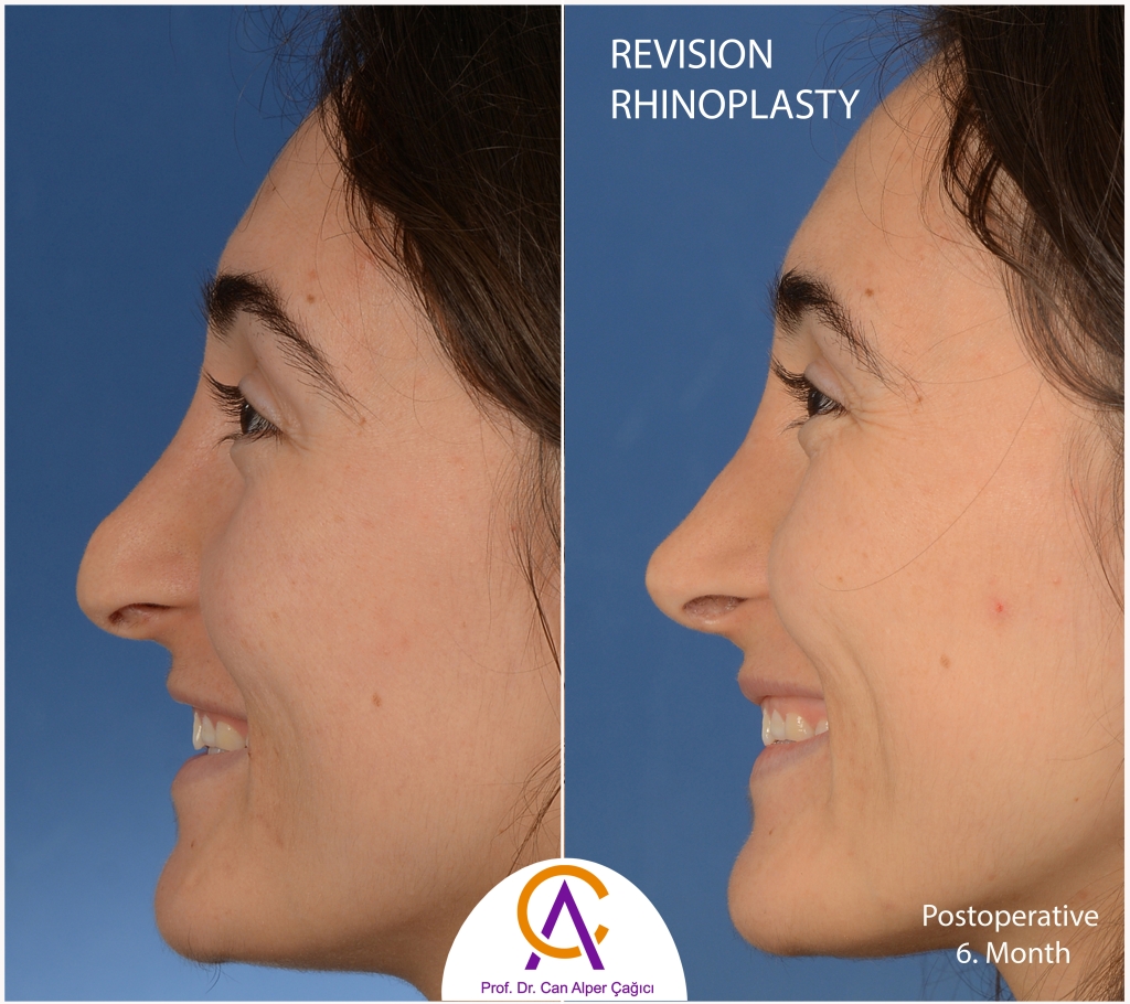 Before and after photos of a female patient who underwent revision rhinoplasty (nose surgery) in Adana. 3