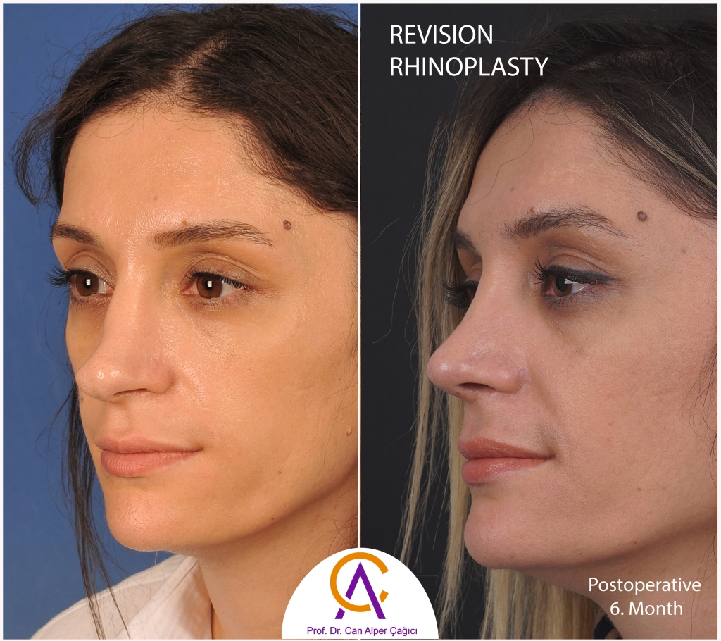 Before and after photos of a female patient who underwent revision rhinoplasty (nose surgery) in Adana. 1