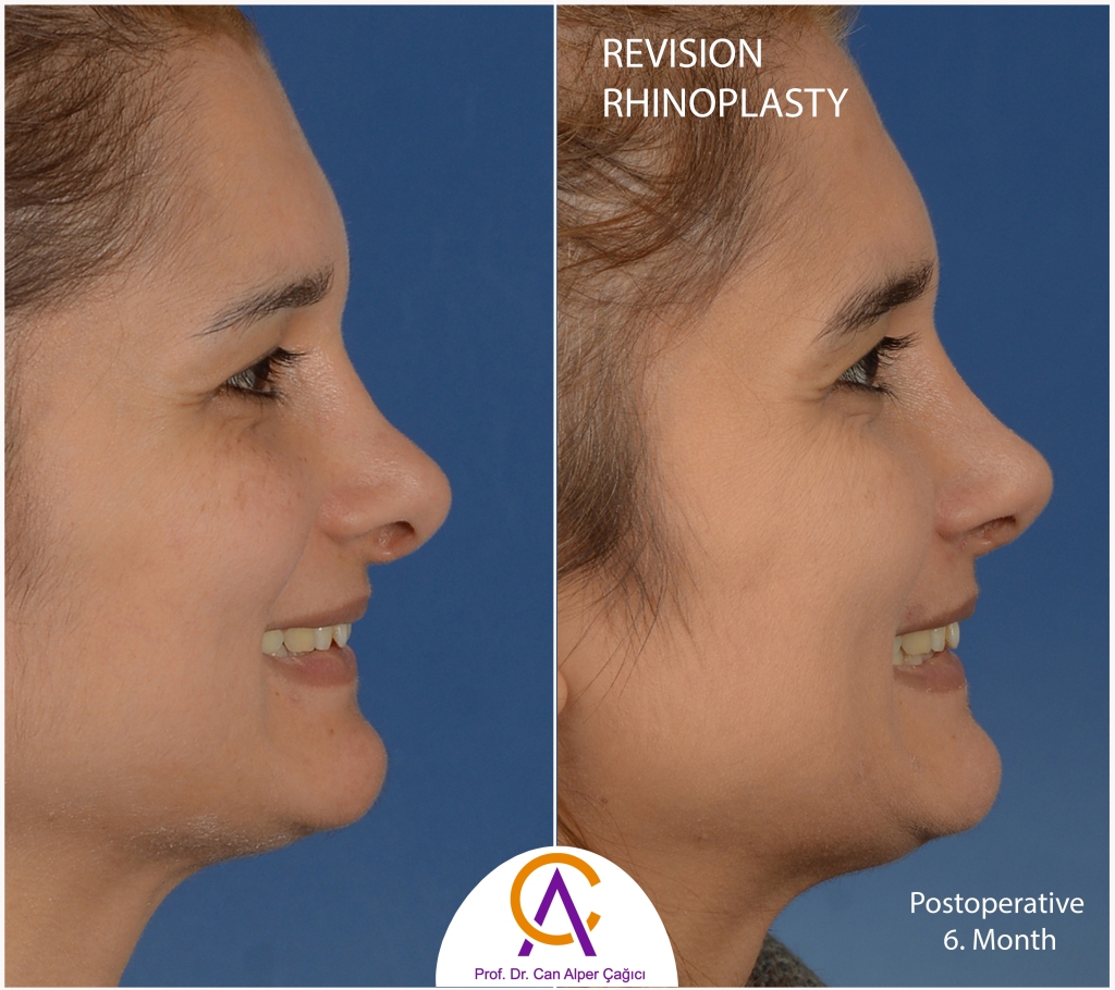 Before and after photos of a female patient who underwent revision rhinoplasty (nose surgery) in Adana. 2