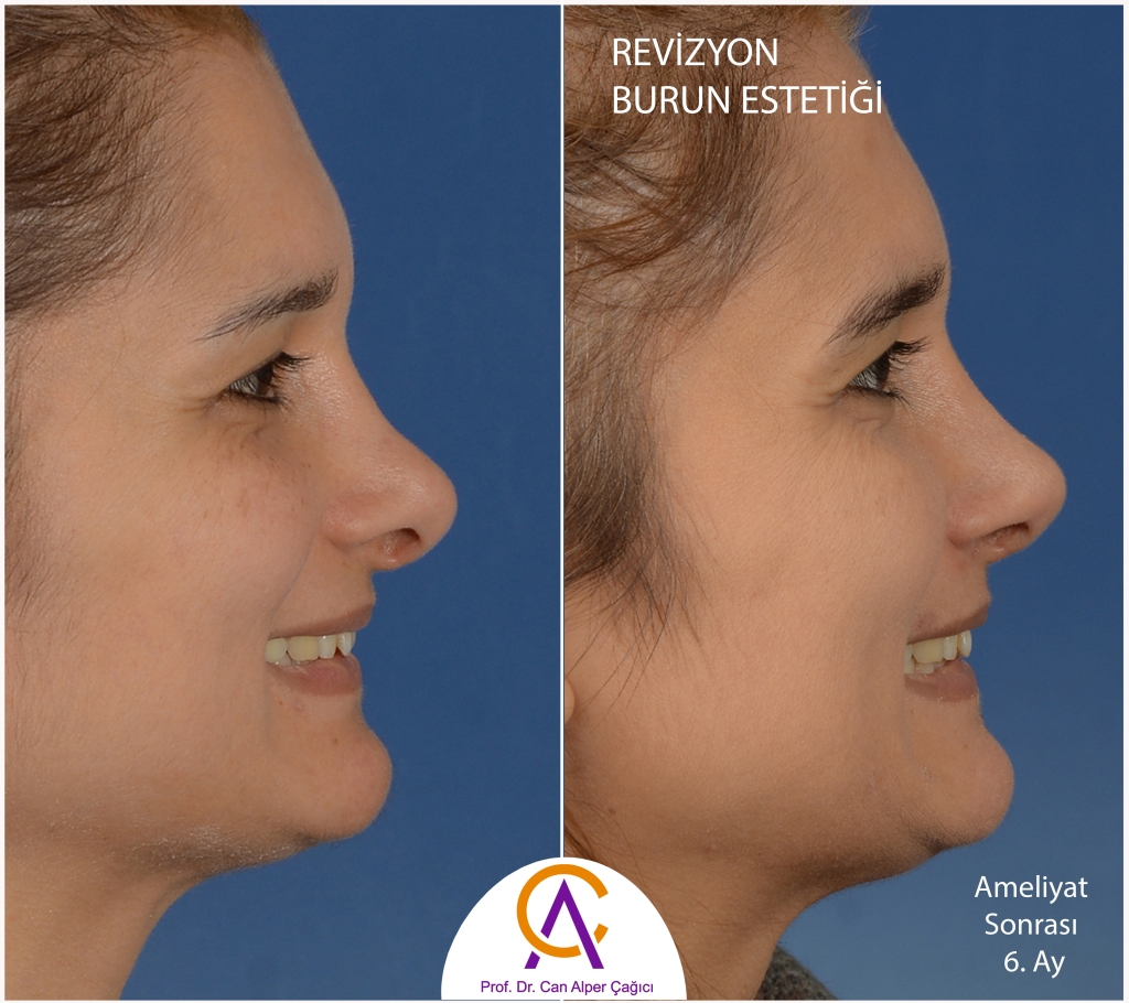 Adana'da revizyon burun estetiği ameliyatı (revizyon rinoplasti) yapılan olan kadın hastanın öncesi sonrası fotoğrafları