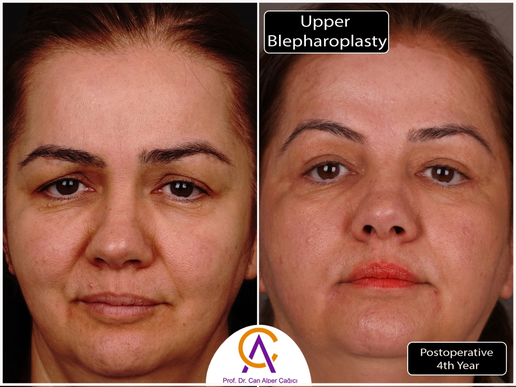 Before and after photos of a patient who underwent upper eyelid surgery (blepharoplasty) in Adana.