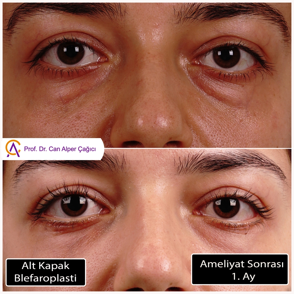 Adana'da alt göz kapağı estetiği (blefaroplasti) ameliyatı olan hastanın öncesi sonrası fotoğrafları