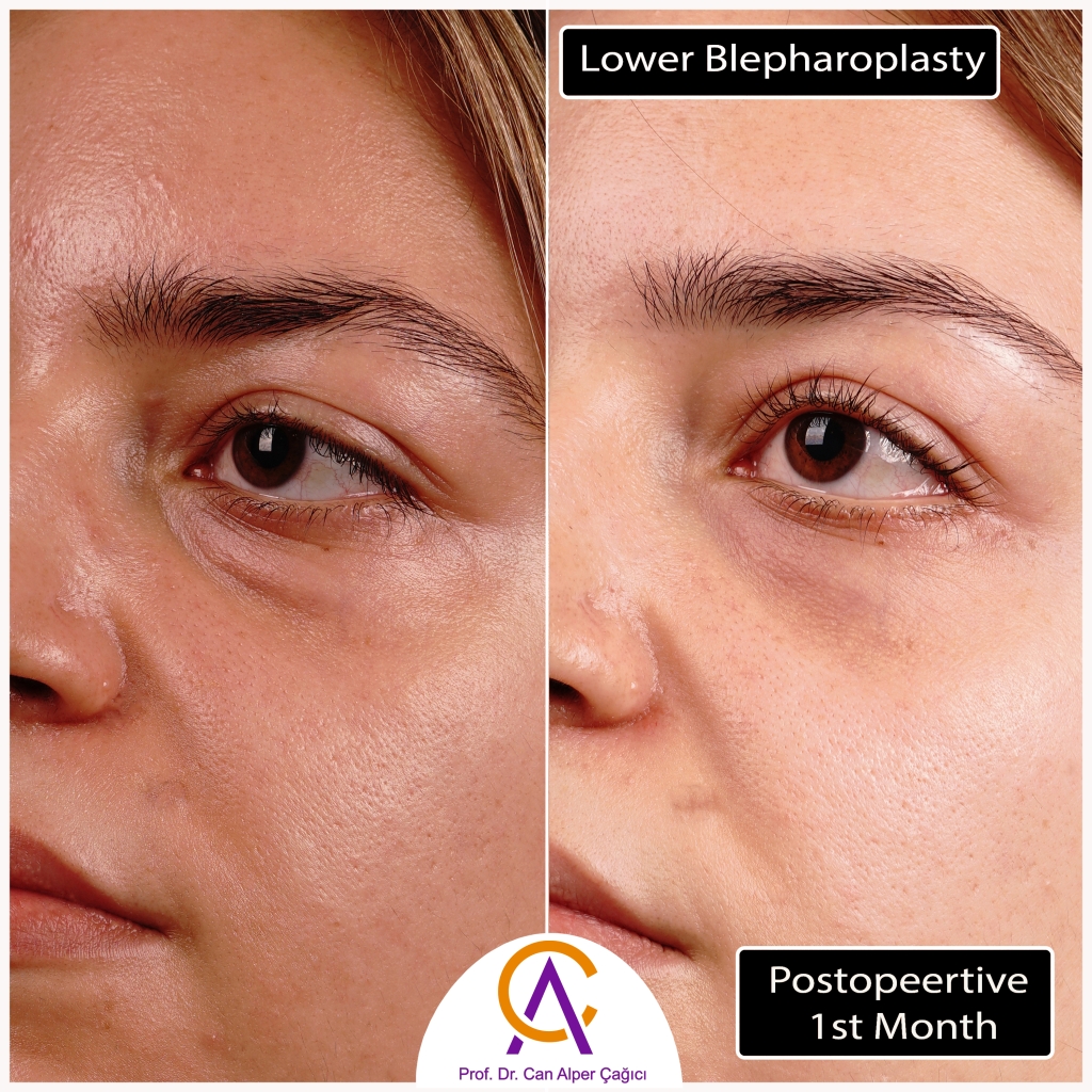 Before and after photos of a patient who underwent lower eyelid surgery (blepharoplasty) in Adana.