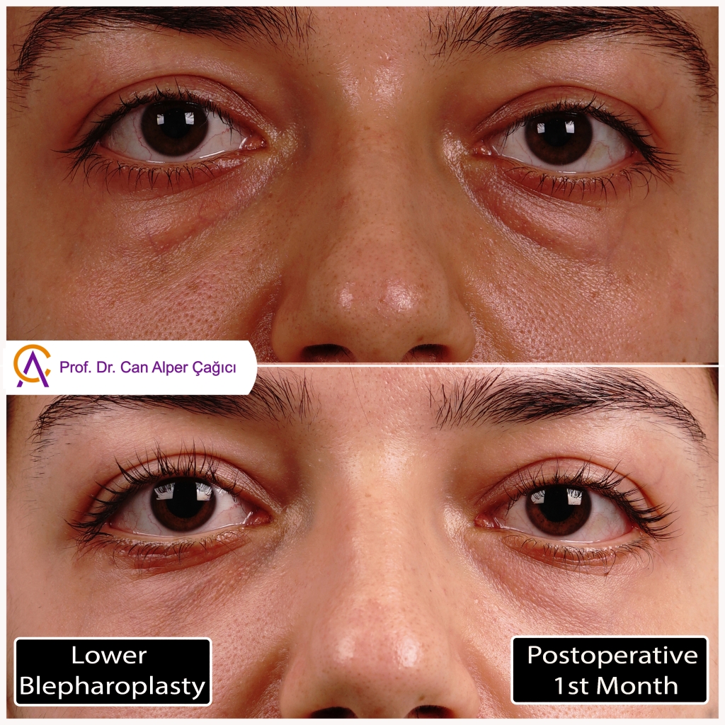Before and after photos of a patient who underwent lower eyelid surgery (blepharoplasty) in Adana.
