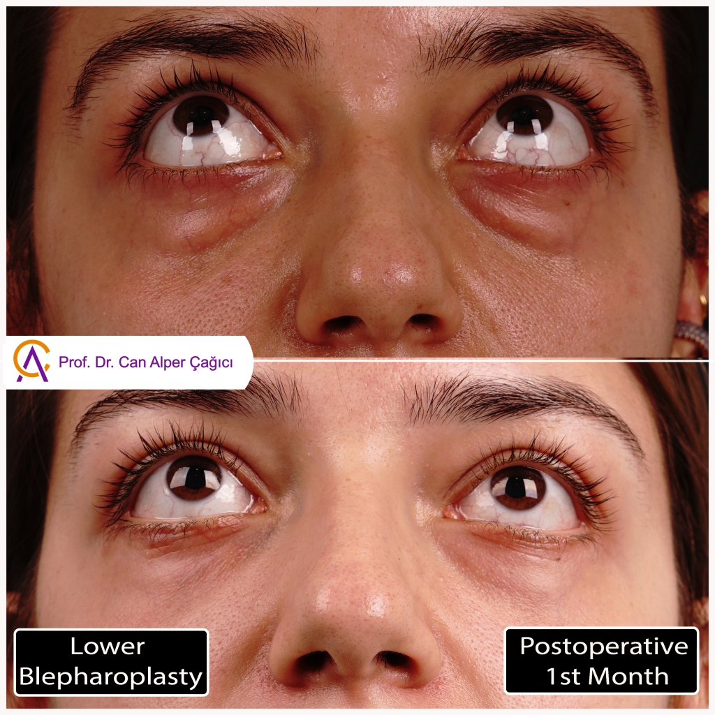 Before and after photos of a patient who underwent lower eyelid surgery (blepharoplasty) in Adana.