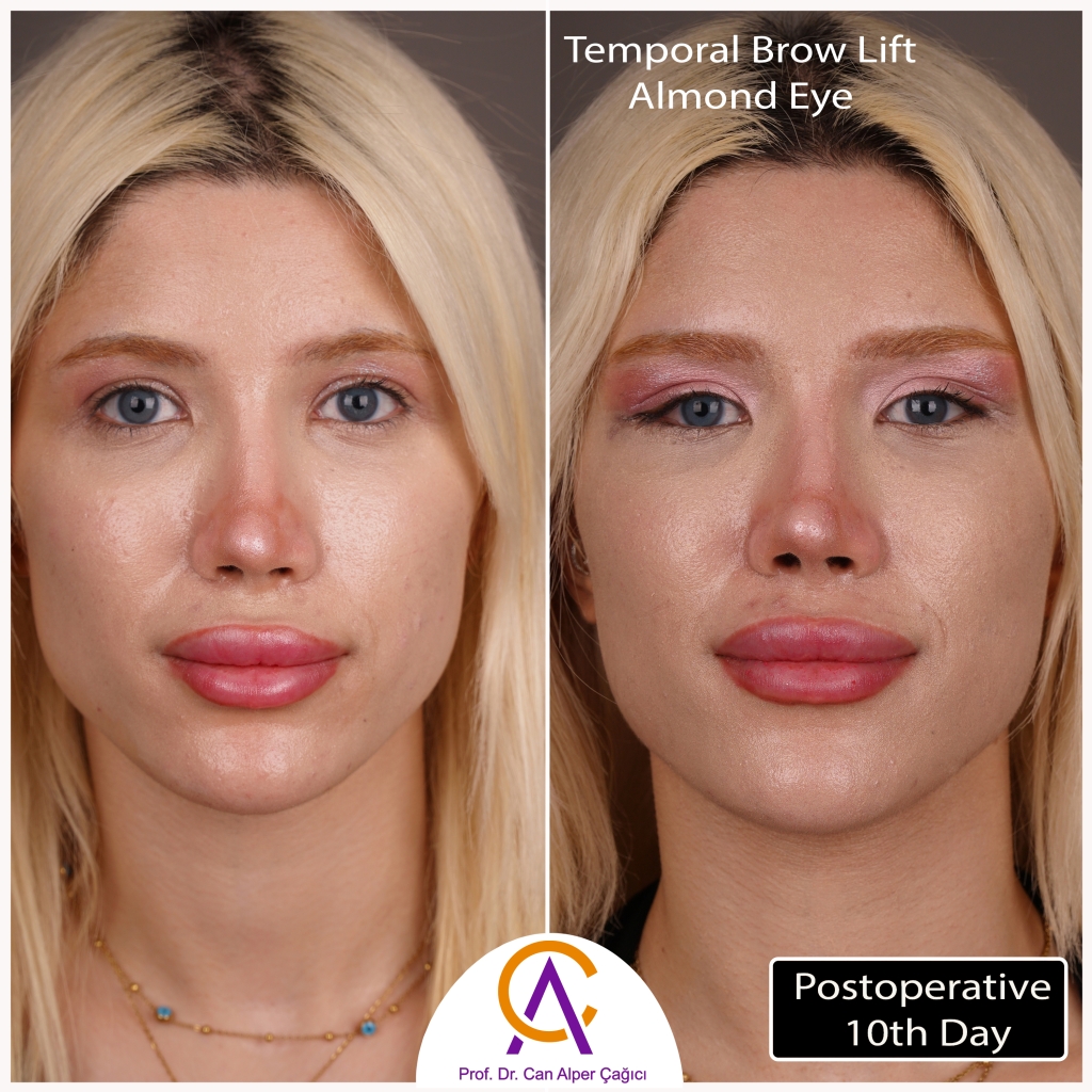 Before and after photos of a patient who underwent almond eye aesthetic surgery in Adana.