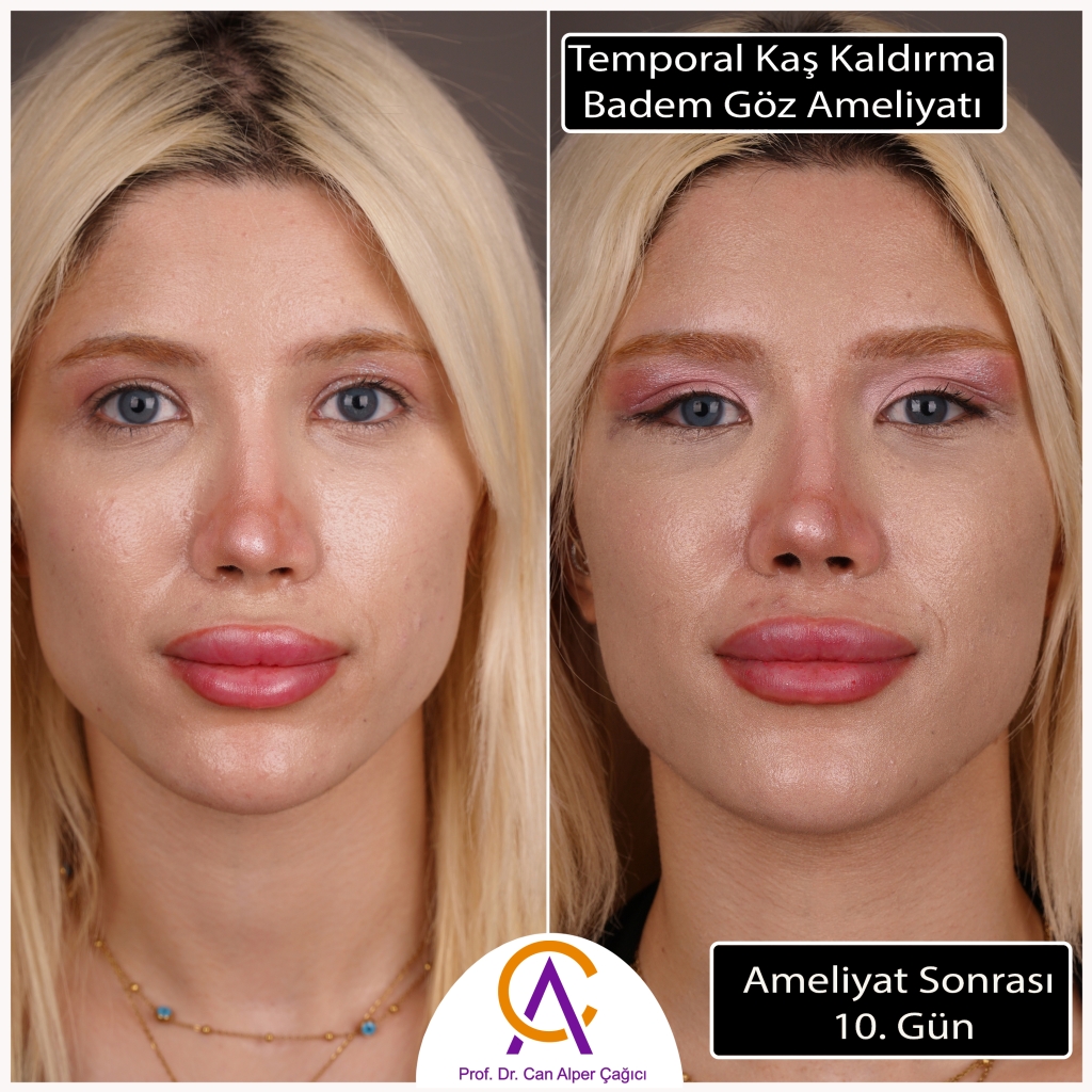 Adana'da temporal kaş kaldrıma ve Badem göz estetiği olmuş kadın hastanın öncesi sonrası görüntüleri