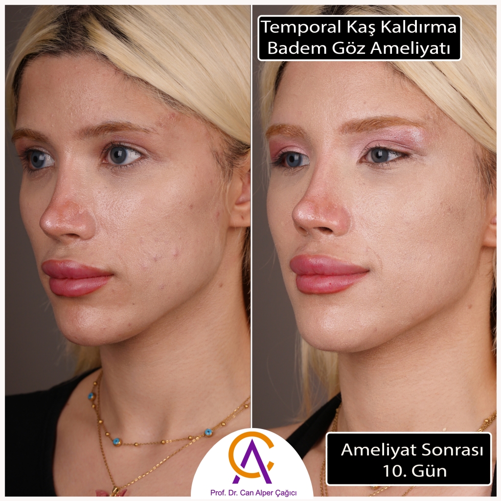 Adana'da Badem göz estetiği olmuş kadın hastanın öncesi sonrası görüntüleri