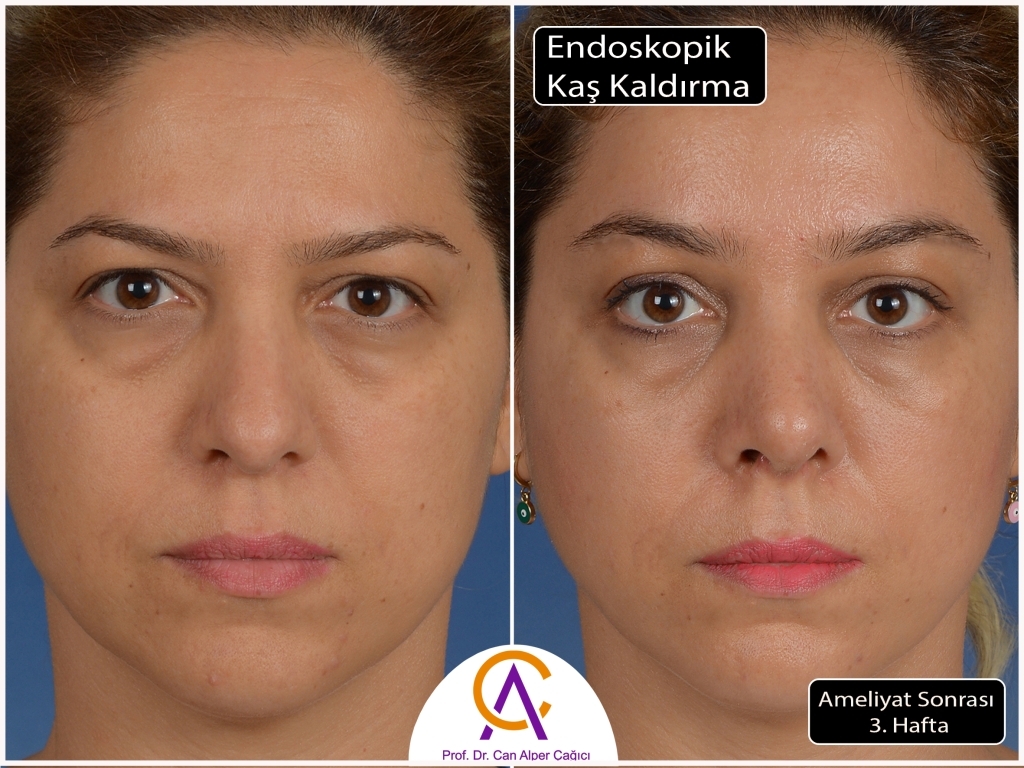 Adana'da endoskopik kaş kaldırma ameliyatı olan hastanın öncesi sonrası fotoğrafları
