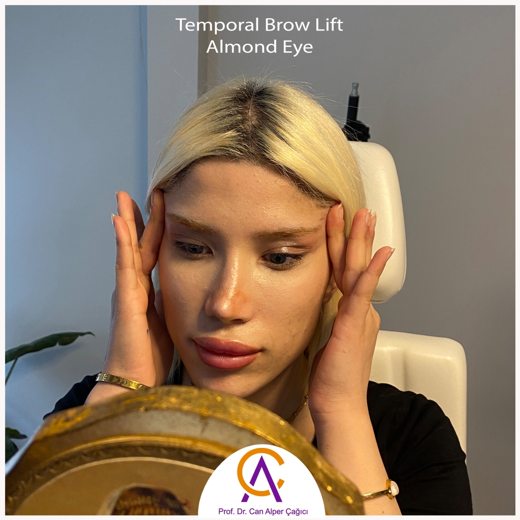 Photo of a patient who underwent almond eye surgery in Adana.