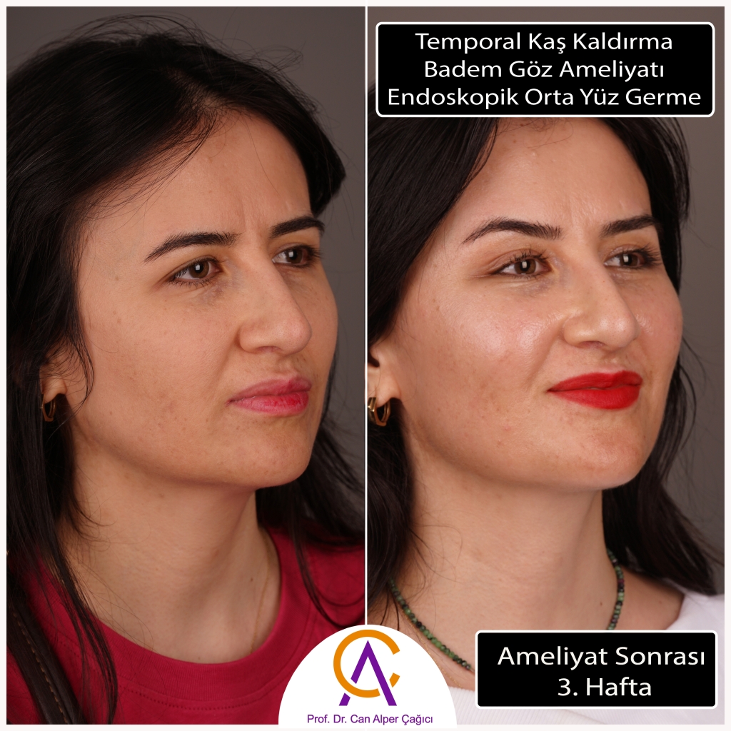 Endoskopik Kaş Kaldırma – Ameliyat Öncesi ve 3. Hafta Sonrası